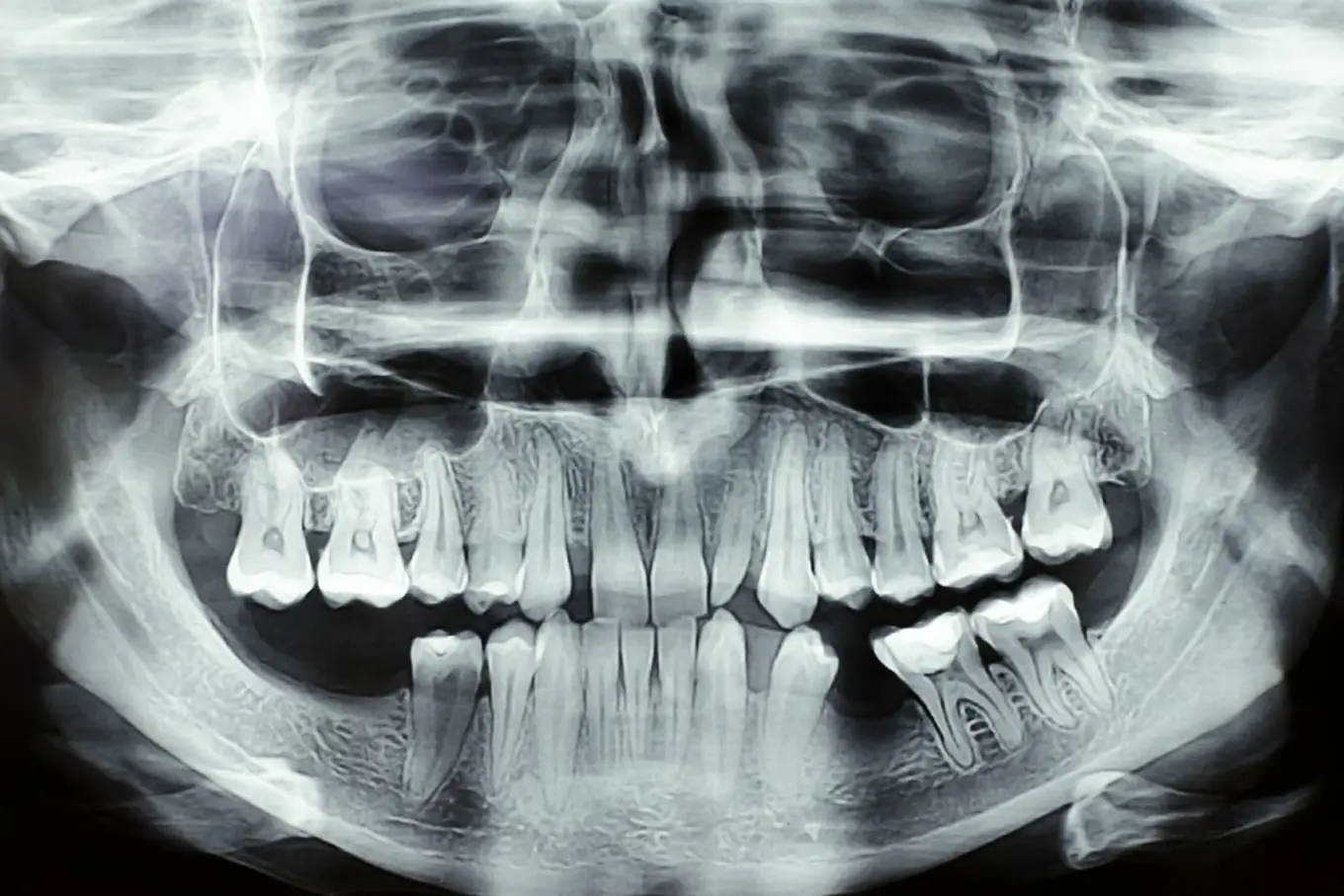 zdjęcie panoramiczne zębów