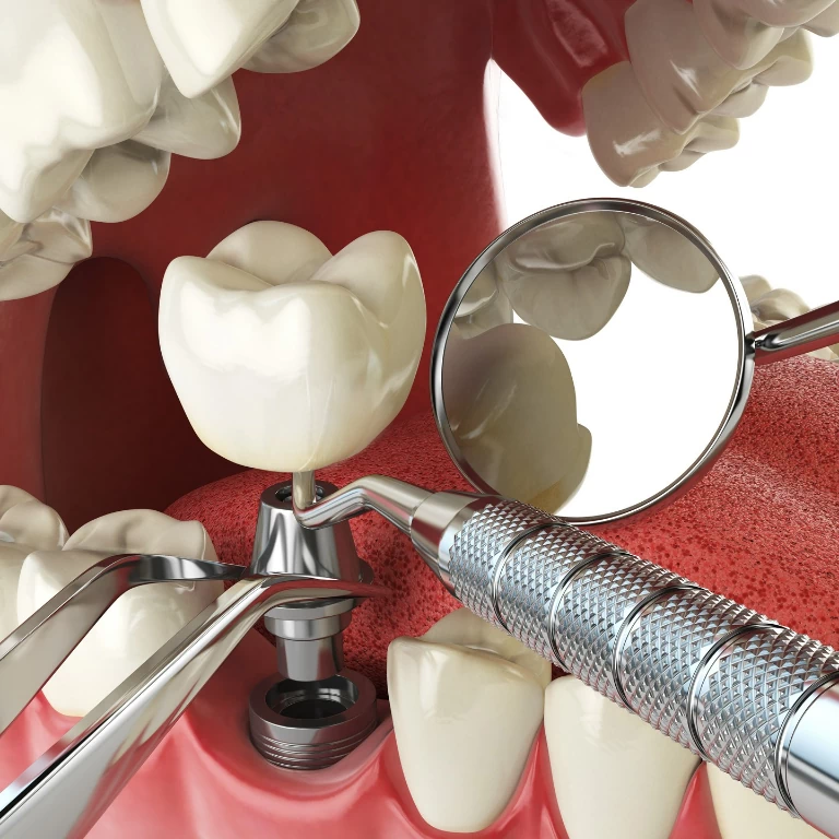 montowanie implantu zęba